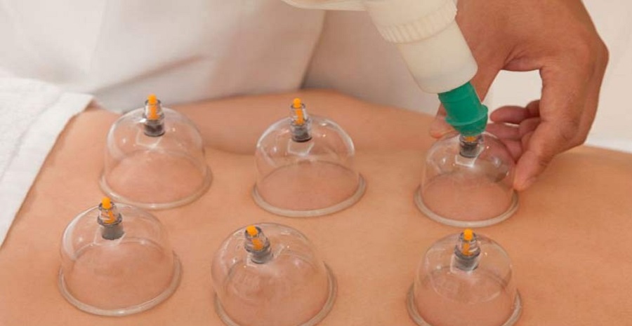 از آغاز بهار تا نیمه ماه قمری، بهترین زمان برای «حجامت» کدام است؟