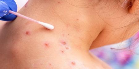  آیا باید از آبله میمونی بترسی؟