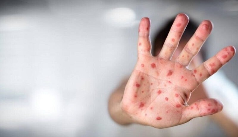 درخواست جهانی برای مقابله فوری با شیوع آبله میمونی