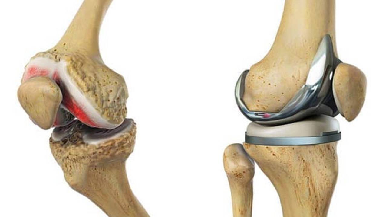 آلیاژی جدید که مثل استخوان در بدن طراحی شده است