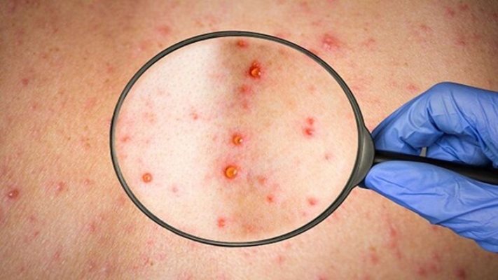 اختصاصی| همه چیز درباره آبله میمون + روش های انتقال