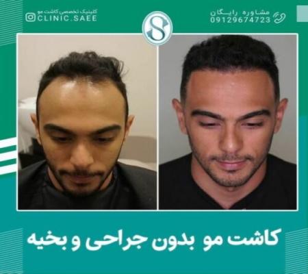 آگهی/ طبیعی‌ترین روش کاشت مو در ایران