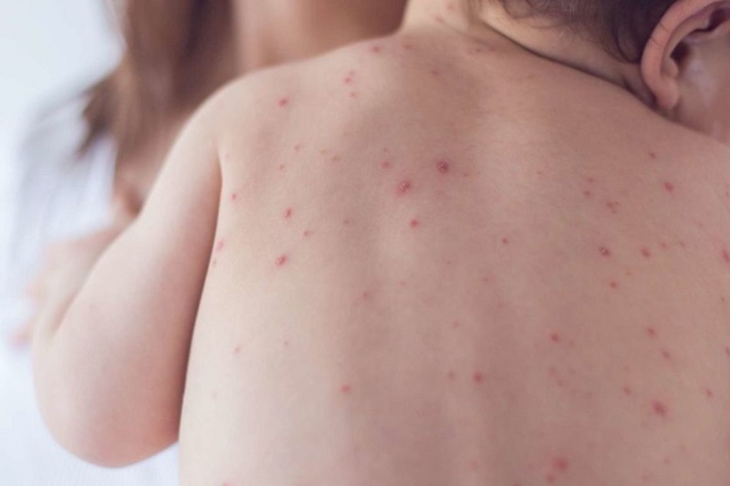 ابتلای پنج نفر به سرخک در دانشگاه علوم پزشکی مشهد 