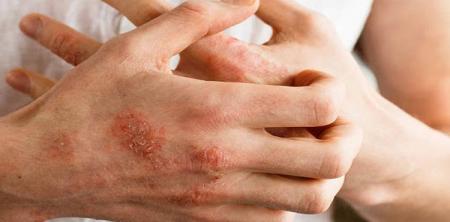 چرا وقتی پوستمان را می خارانیم خارشش بیشتر می شود؟