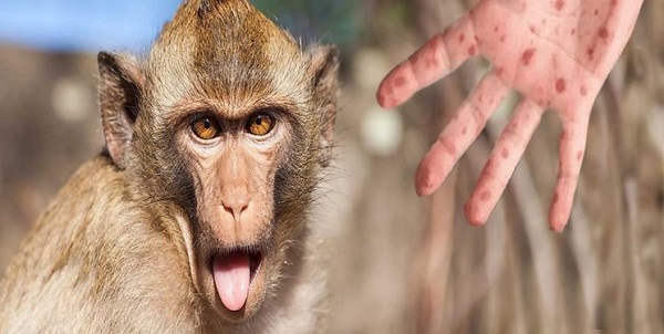 جهش غیر عادی و سریع  ویروس آبله میمونی 
