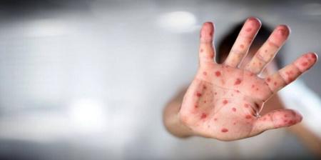 ایرانیان متولد این سال ها در برابر آبله میمونی مصون هستند