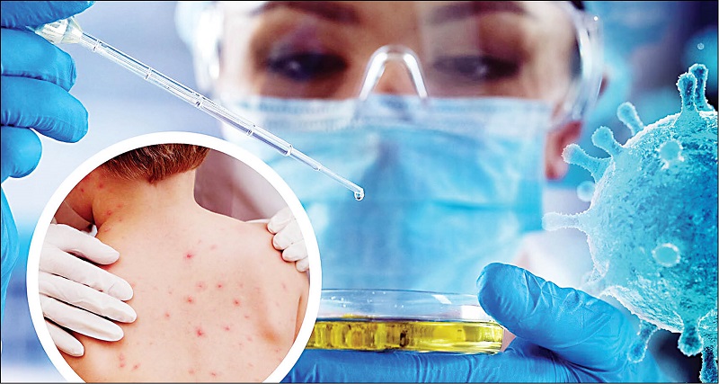 اختصاصی|  چگونه آبله میمونی به انسان رسید؟