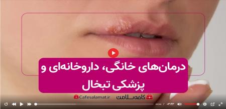 درمان‌های خانگی، داروخانه‌ای و پزشکی تبخال