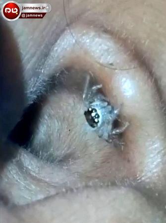 لحظه هولناک خارج کردن عنکبوت از گوش + تصاویر