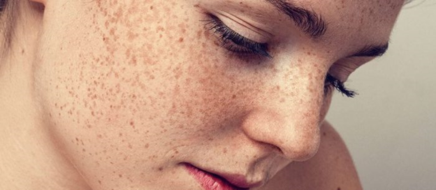 آگهی| علت و درمان لک و جوش صورت + معرفی دکتر پوست خوب