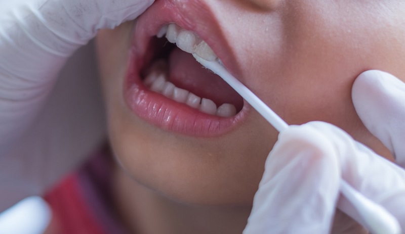 روش  استفاده از وارنیش فلوراید برای پیشگیری از پوسیدگی دندان