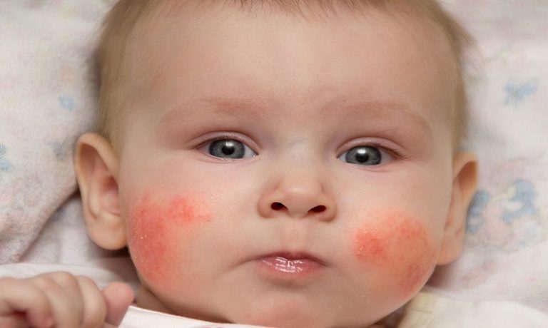  علت باورنکردنی جوش پوستی در نوزادان چیست؟
