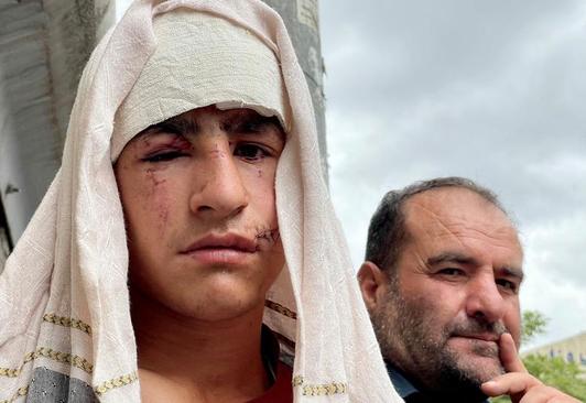 یک جوان زخمی از انفجارهای تروریستی شهر کابل + عکس