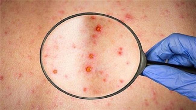 شباهت علائم آبله میمونی و آبله مرغان