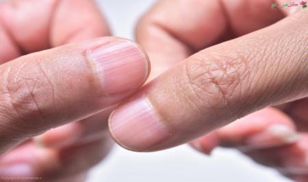  دلیل بروز انواع خط  روی ناخن چیست؟