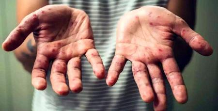  آبله میمونی به این زودی ها از بین نمی رود