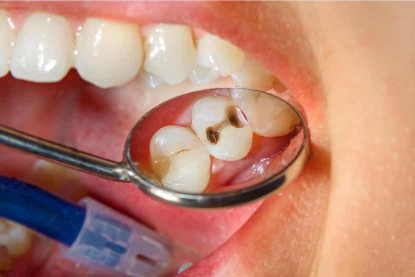 ترجمه اختصاصی/پالپیت یا عفونت داخلی دندان چیست وچگونه درمان می شود؟