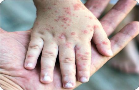 چرا شیوع سرخک یک تهدید در سطح جهانی به شمار می‌آید؟