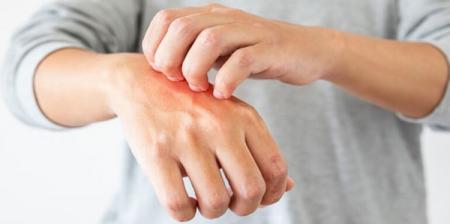 استرس این بیماری‌های پوستی را وخیم‌تر می‌کند/ اینفوگرافیک