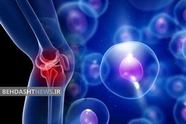  شیوع نرمی کشکک زانو در دختران جوان/ چگونه این بیماری را کنترل کنیم؟