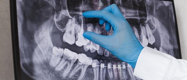 آگهی/ عصب کشی مجدد یا درمان مجدد ریشه دندان چیست؟