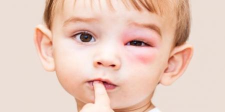 گل مژه در کودکان، علائم و درمان/ اینفوگرافیک
