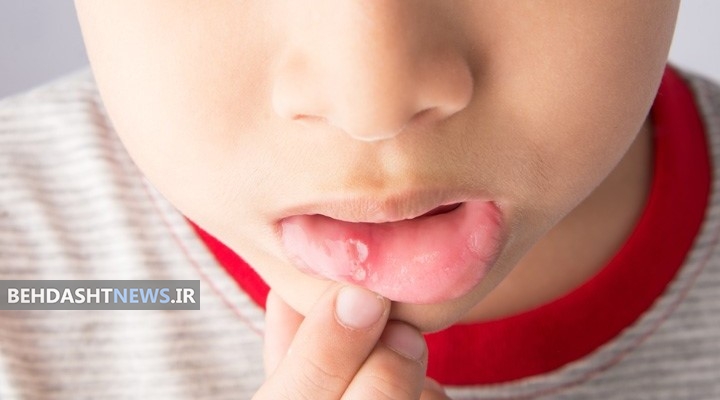 روش درمان زخم های دهانی کودکان
