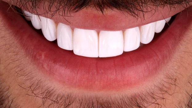 آگهی/ لمینت دندان چیست؟ | هرآنچه لازم است از لمینت دندان بدانید!