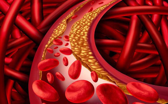 راهکارهایی برای درمان چربی خون بالا + اینفوگرافیک
