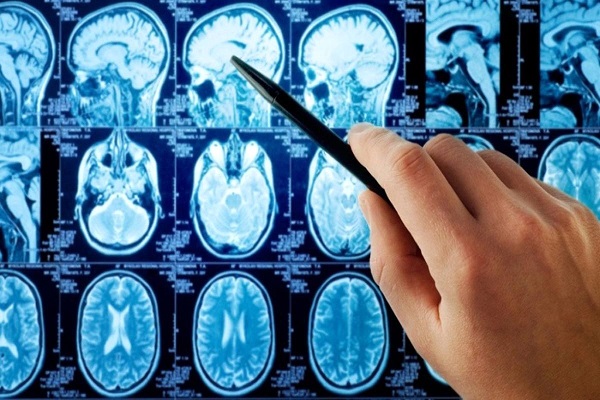 ژلی که بدحالت ترین تومورهای مغز را از بین می برد