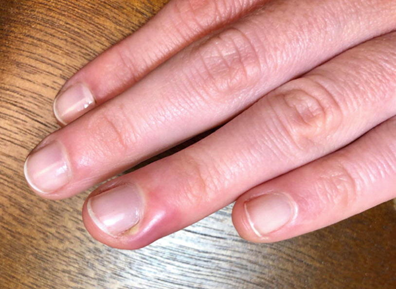 راهکارهایی برای پیشگیری از عقربک یا عفونت پوست اطراف ناخن