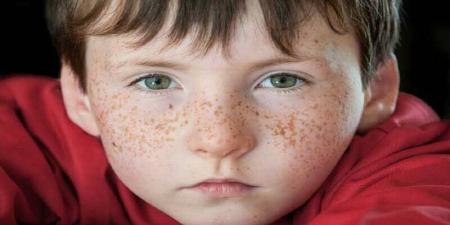 تفاوت بین لکه پوستی مادرزادی و خال چیست؟