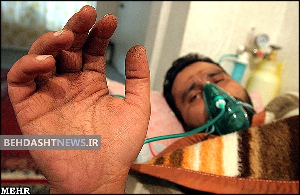 زندگی جانبازان شیمیایی مانند نفسشان به سختی می گذرد