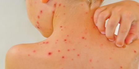 چگونه به ویروس آبله مرغان مبتلا می‌شوید؟