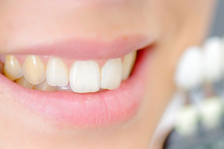 ۴ روش خانگی برای رفع زردی دندان 