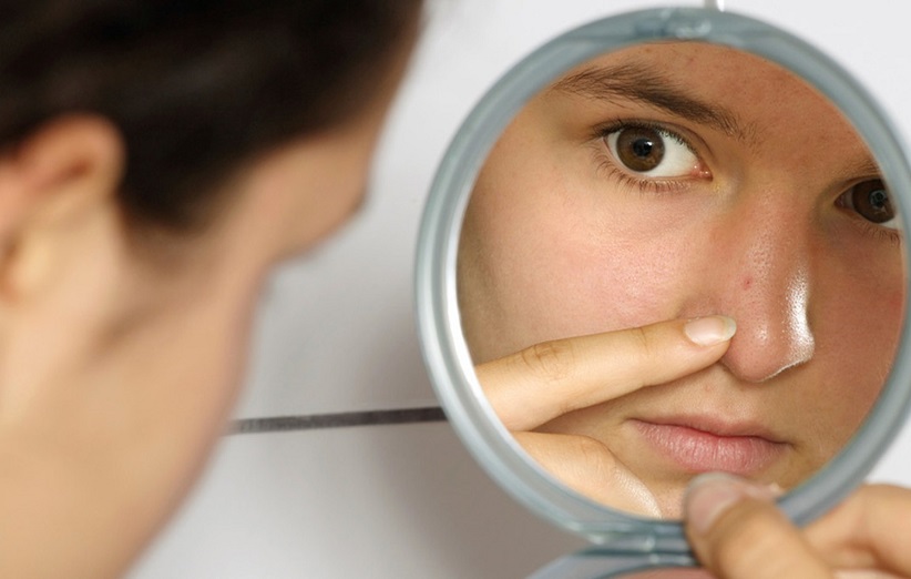 روشی جدید و موفقیت آمیز برای درمان جوش های صورت