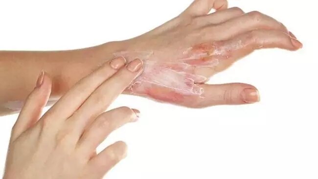 سوختگی پوست را با این روش درمان کنید