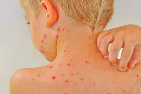 با این روش ها از مبتلا شدن به سالک جلوگیری کنید