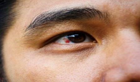 علت ایجاد لکه خون در چشم چیست؟