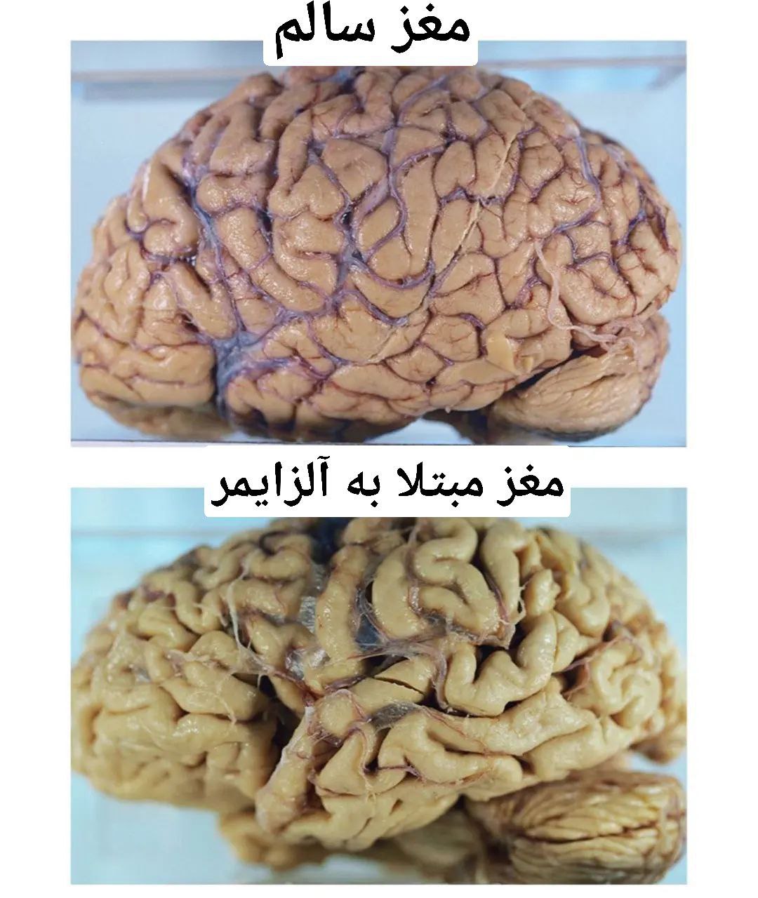 تصویر عجیب از تفاوت مغز فرد سالم با مغز یک فرد مبتلا به آلزایمر+عکس