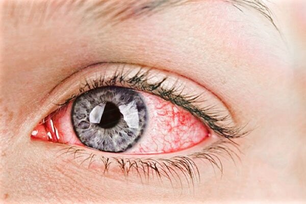 کشف درمانی تازه برای التهاب چشم