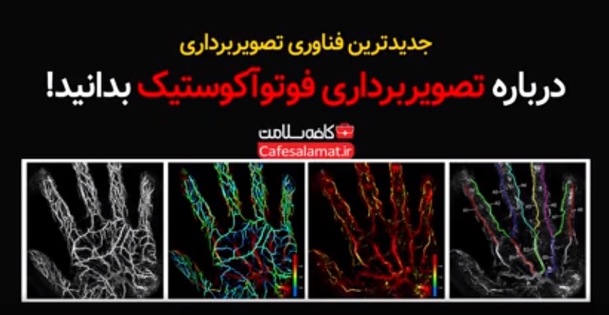 درباره تصویربرداری فوتوآکوستیک بدانید!