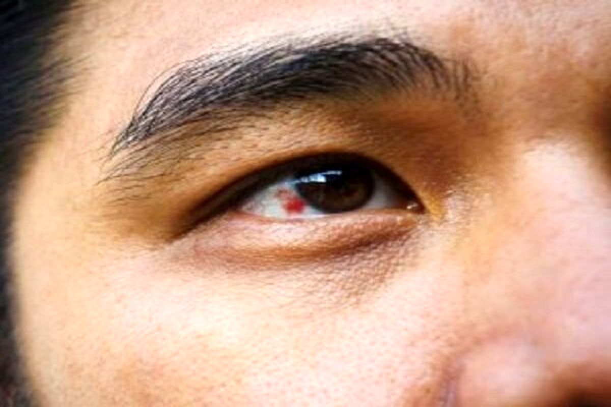 درجه بندی میزان خون در چشم + عوارض