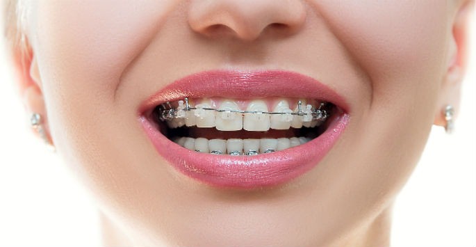  ارتودنسی به قیمت از دست رفتن سلامتی