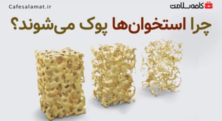 چرا استخوان‌ها پوک می‌شوند؟