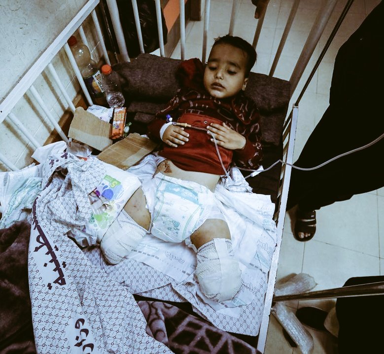 تصویر دردناک از کودک اهل غزه که دویدن برایش آرزو شد+عکس