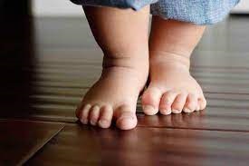 شیوه های تشخیص و درمان صافی کف پا، در کودکان و بالغین متفاوت است