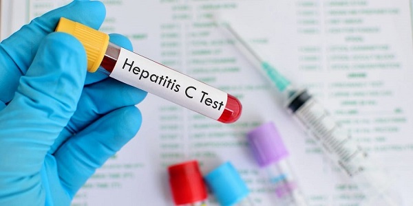  اقدماتی که قرار است وزارت بهداشت برای حذف بیماری هپاتیت C در کشور انجام دهد