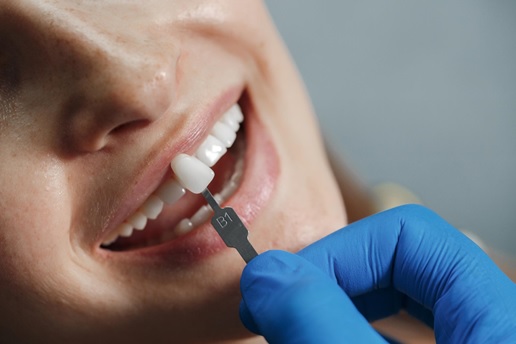 آگهی/ هر آنچه درباره لمینت دندان باید بدانید