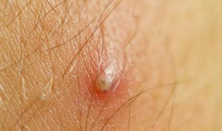 موهای زیرپوستی آزارتان می‌دهد؟ این ۶ روش سه سوته خلاص‌تان می‌کند